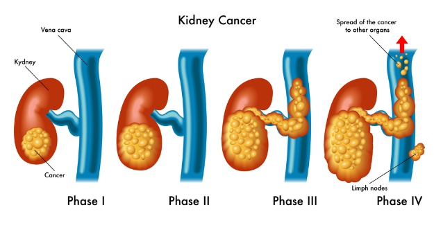 What Is Kidney Cancer? | Can Stem Cells Be Used In Kidney Cancer Treatments?