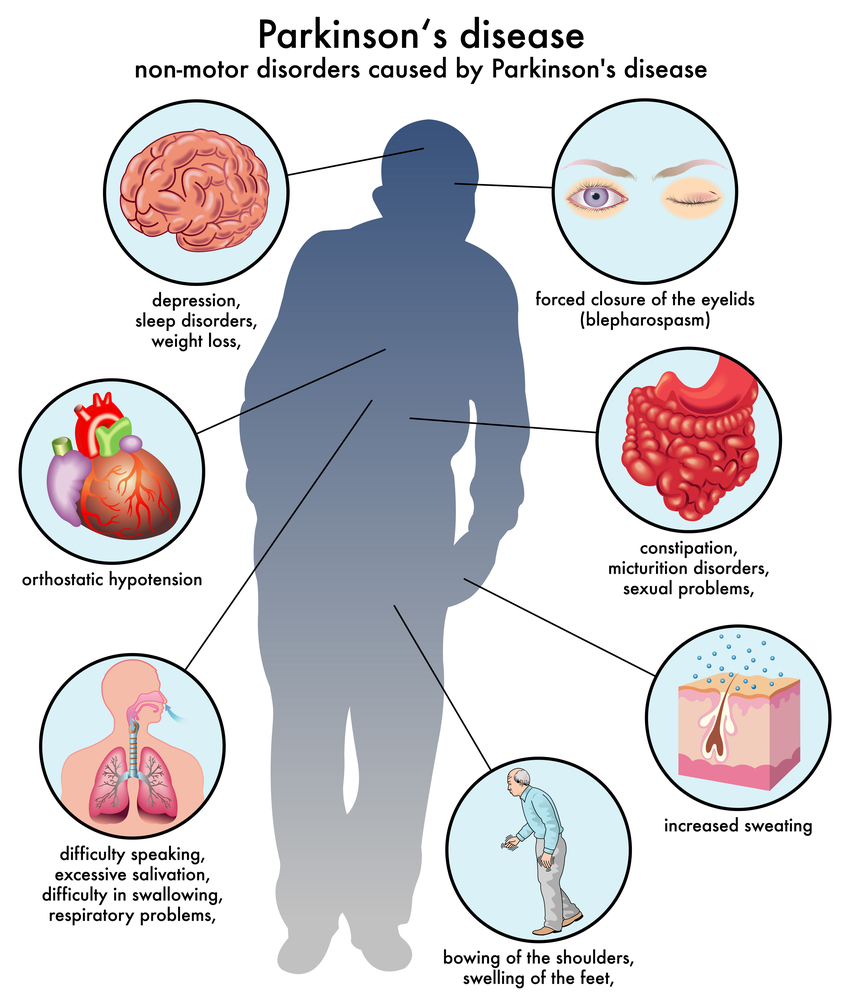 What Is Parkinson's Disease? | Stem Cell Treatment for Parkinson's Disease