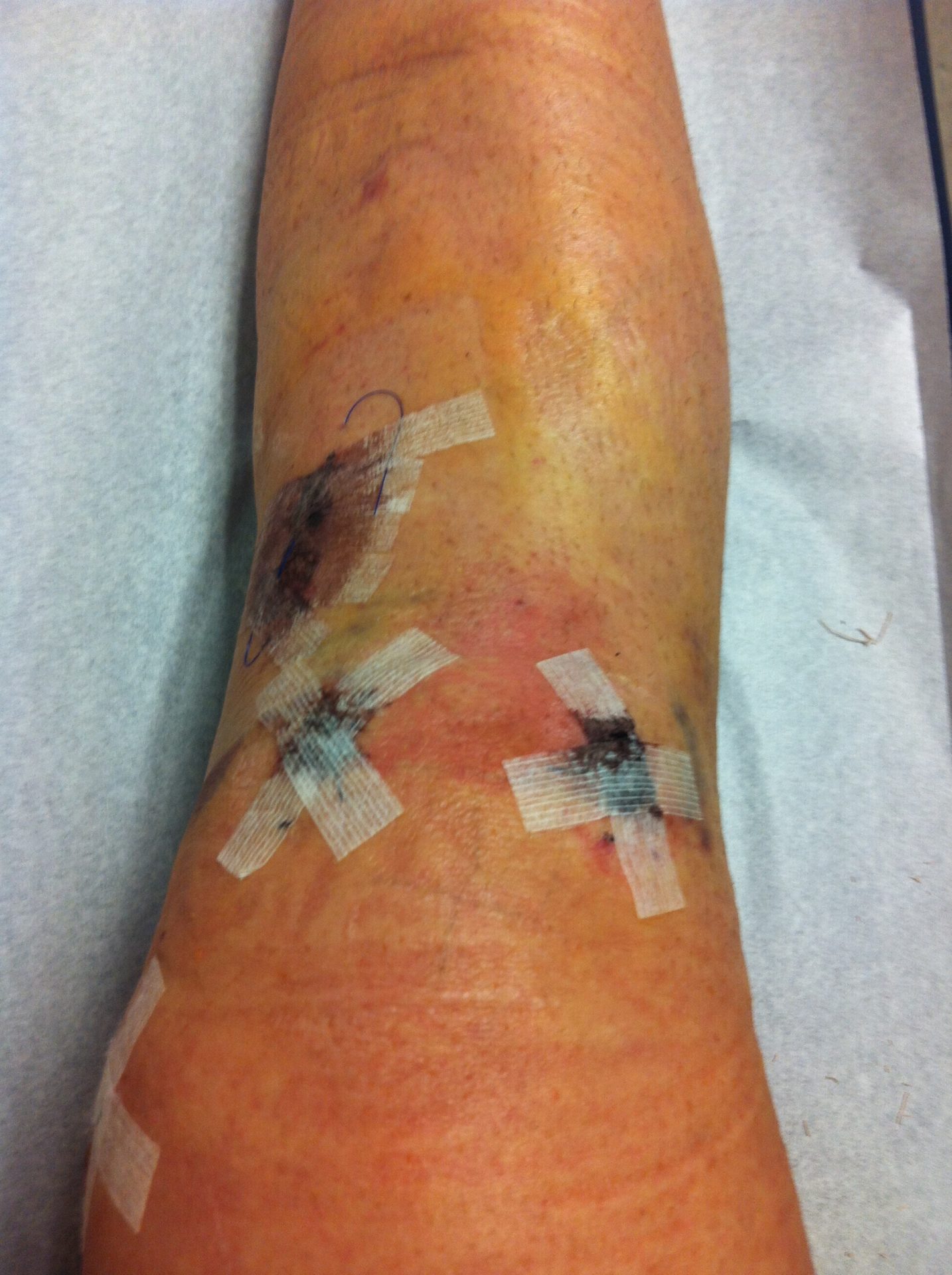 Photo post knee-surgery and pre stem cell injection