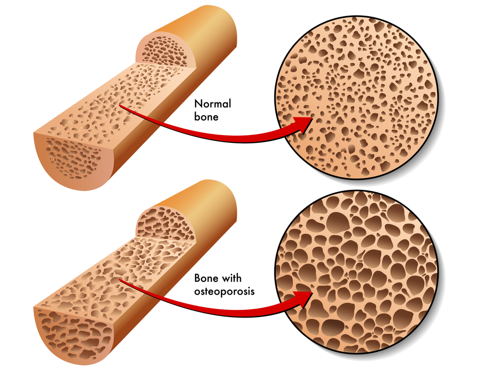 3 Bullet Thursday - Inducing Bone, Growing Vocal Cords, & Solving Duchenne Muscular Dystrophy