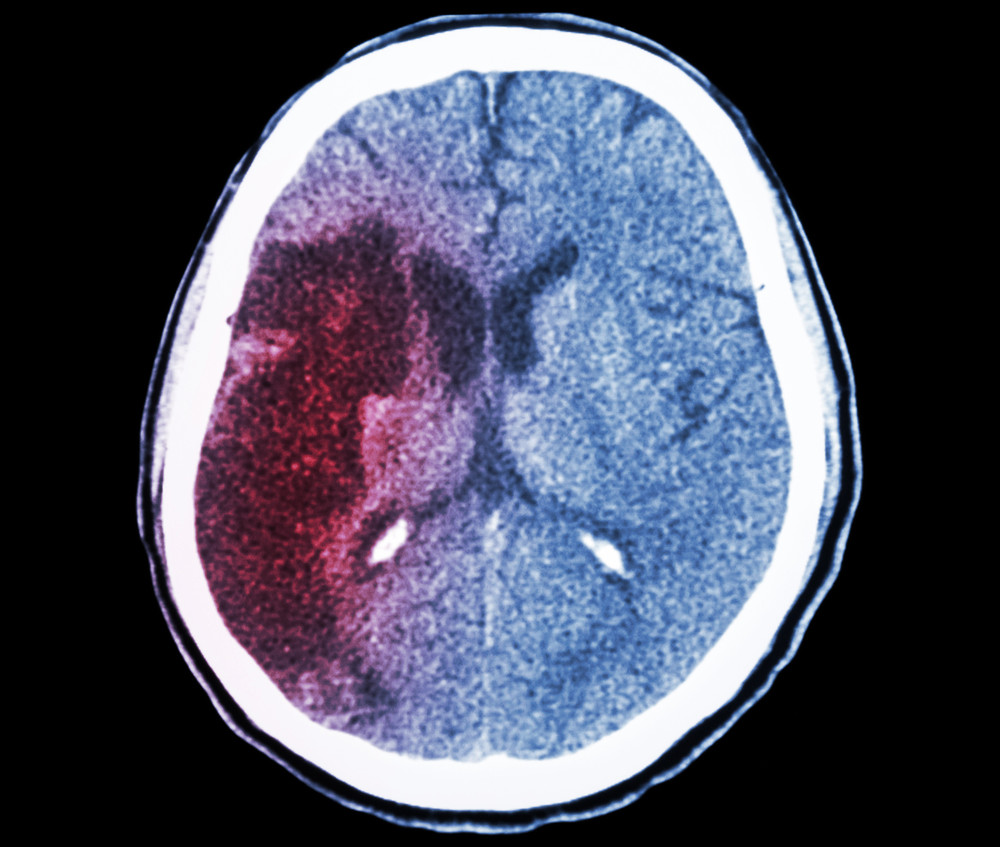 SanBio and Sunovion Recruiting for Phase 2b Trial for Cell Therapy Approach to Ischemic Stroke