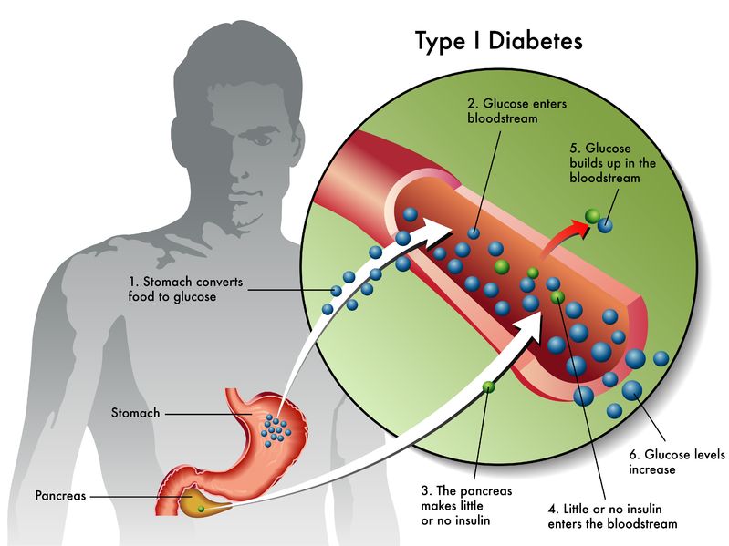 Joint Research Collaboration Aims to Advance Human Clinical Trials for the Treatment of Hypoglycemic Unawareness Patients with Severe Type 1 Diabetes - 17727298 - type 1 diabetes