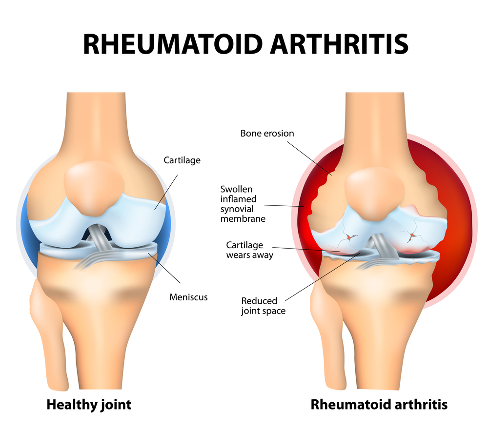 Phase 2 Trial Results of Mesoblast’s Cell Therapy Show Dose-Related Improvements in Biologic Refractory Rheumatoid Arthritis