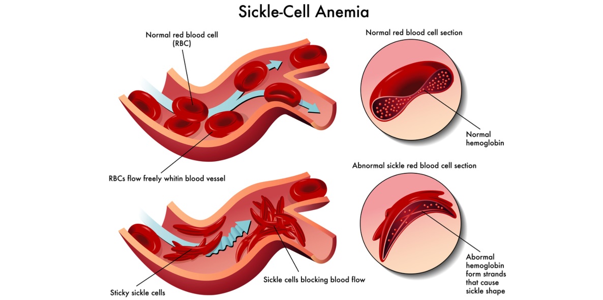 Sickle Cell Cryo-Save