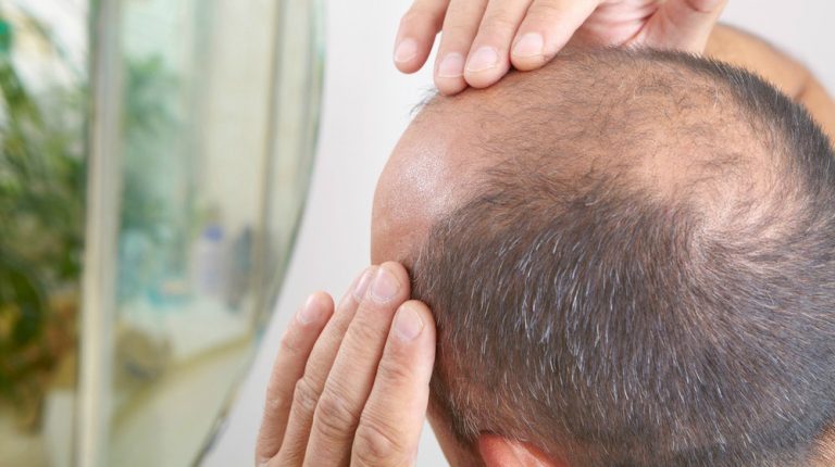 Feature | Stem Cell Treatment For Hair Loss