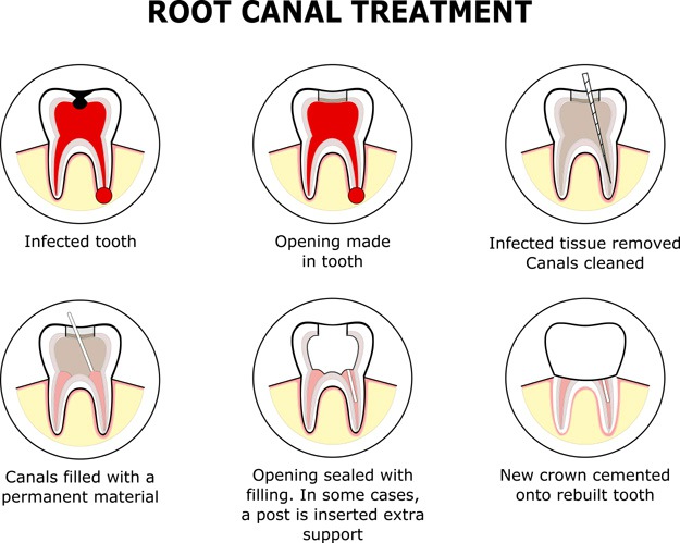 What Is a Root Canal? | Stem Cell Fillings Replace The Need For Root Canal Procedure