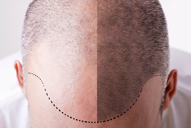 Progress In Stem Cell Treatment For Hair Loss | BioInformant