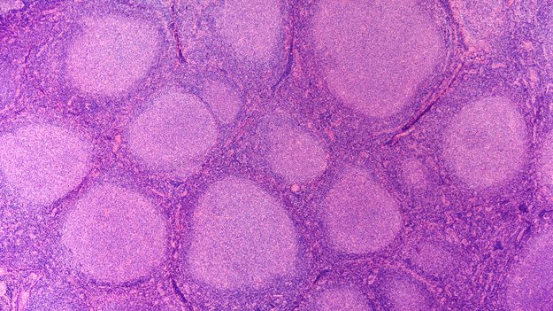 Non-Hodgkin’s Lymphoma | Top Most Popular Stem Cell Treatments