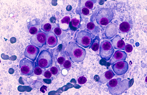 Multiple Myeloma | T Cells For Immune Defense