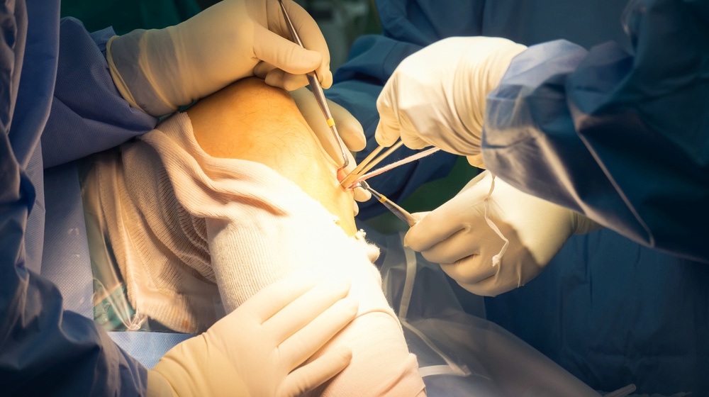 Feature | ACL Surgeries: How To Avoid Surgery With Stem Cell Treatment