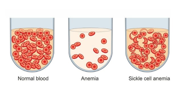 Sickle Cell Disease | Current and Potential Uses of Stem Cells