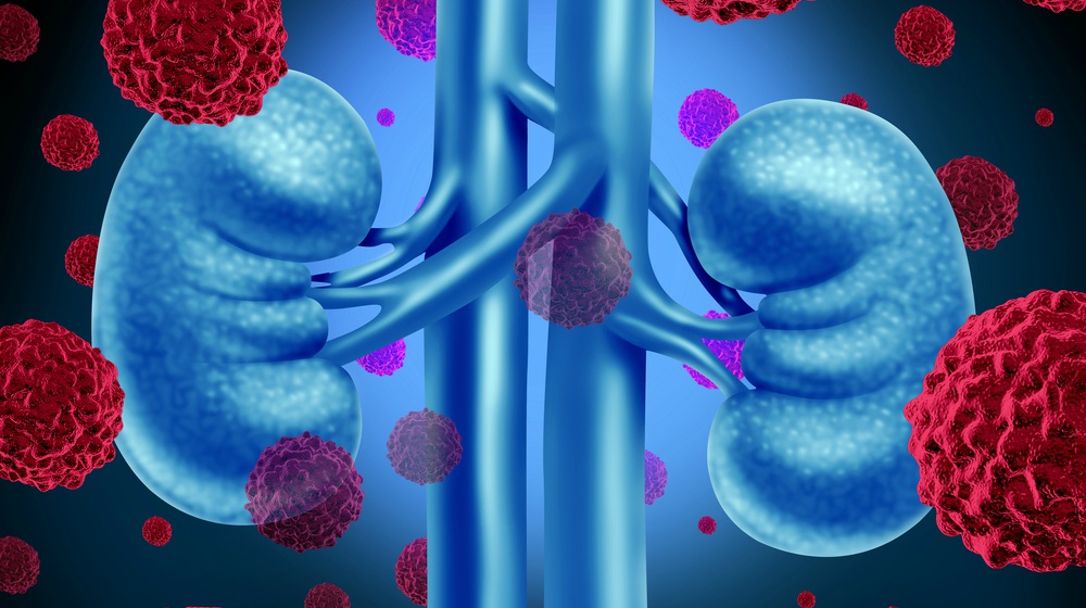 Feature | Can Stem Cells Be Used In Kidney Cancer Treatments?