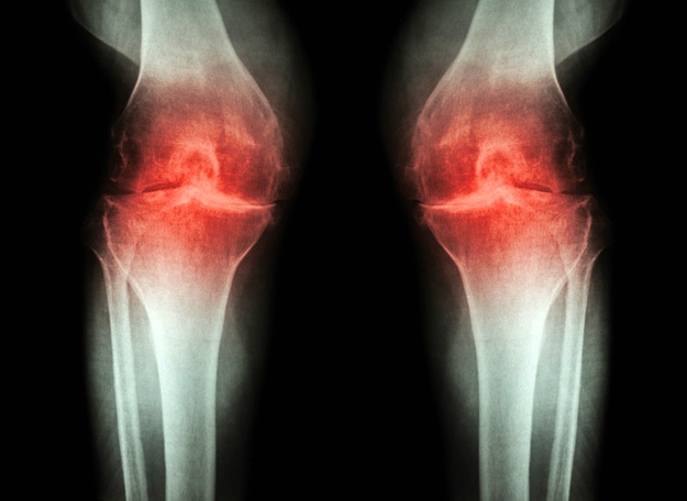 什么是骨关节炎？ |  基于干细胞的骨关节炎治疗