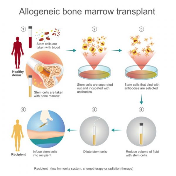 autologous stem cell transplant procedure