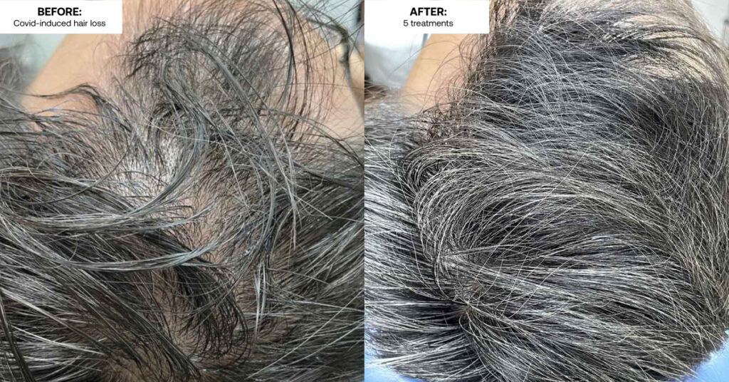 COVID-induced hair loss