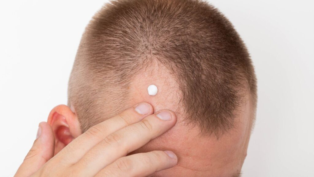 Cutting edge hair restoration