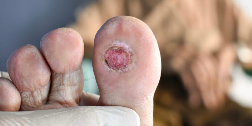 Regenerative Treatments for Diabetic Wound Care