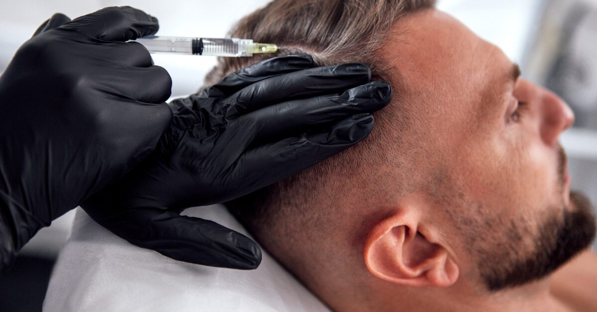 Exosomes hair loss
